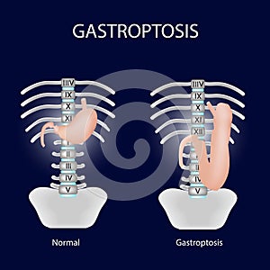 Gastroptosis stomach. The omission of the stomach. Stage gastroptosis. Vector illustration