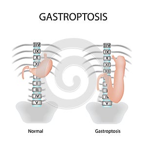 Gastroptosis stomach. The omission of the stomach. Stage gastroptosis. Vector illustration on background