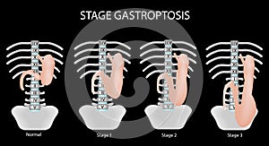 Gastroptosis stomach. The omission of the stomach. Stage gastroptosis. Vector illustration on a black background