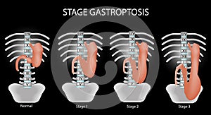 Gastroptosis stomach. The omission of the stomach. Stage gastroptosis. Vector illustration on a black background