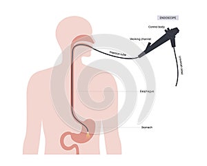 Gastroscopy endoscopy procedure