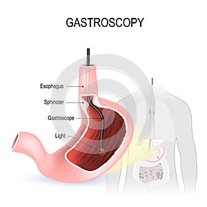 Gastroscopy, Esophagoscopy and duodenoscopy