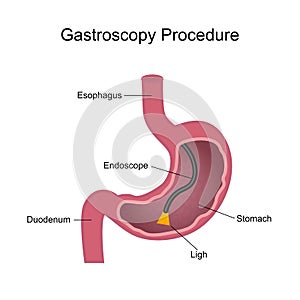 Gastroscopy Procedure Diagram