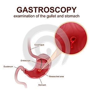 Gastroscopy procedure EGD