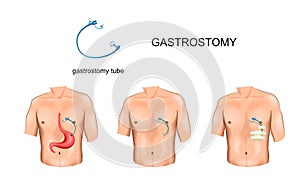 Gastrostomy tube. surgery