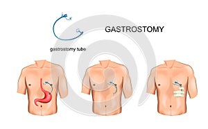 Gastrostomy tube. surgery photo