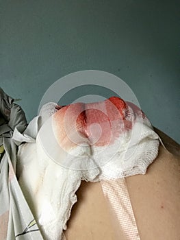 Gauze swab soaked in blood. Attached to the patient`s shoulder after surgery on the collarbone.