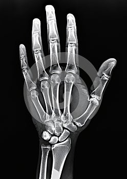 X-ray image of a human hand showing detailed skeletal structure.