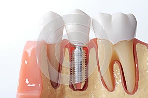 Generic dental teeth model