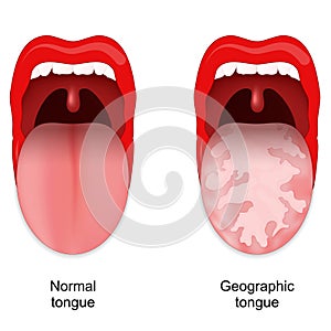 Geographic tongue. Benign migratory glossitis