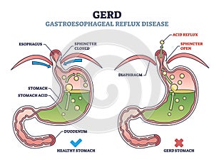 GERD or gastroesophageal reflux disease with digestive acid outline diagram