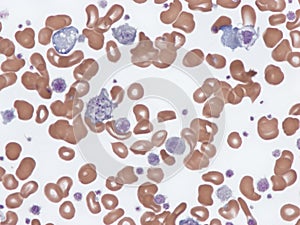 Giant platelets in peripheral blood.