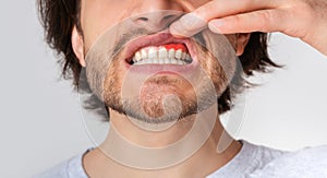 Gingival inflammation and dental problems. Guy pushes his lip up and shows red gum photo