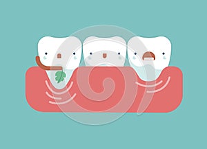 Gingival recession ,dental concept