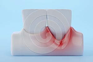 Gingival Recession teeth and gums