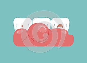 Gingivitis around the teeth ,dental concept