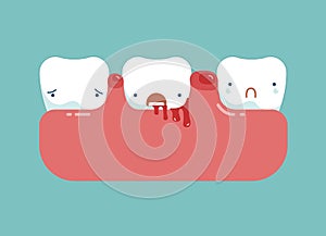 Gingivitis and blood ,dental concept