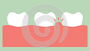 Gingivitis or gum disease, gum inflammation before periodontal disease