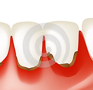Gingivitis. Inflammation of the gums. Dental calculus. Infographics. Vector illustration on isolated background photo