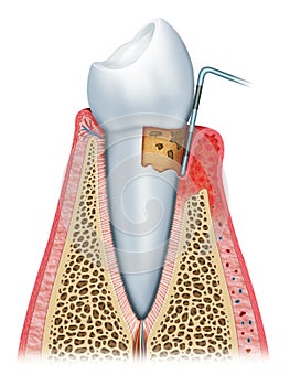 Gingivitis in its second stage