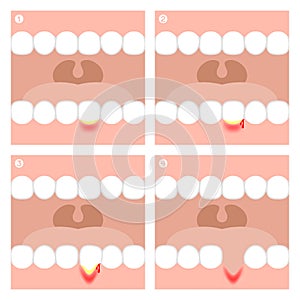 Gingivitis or Periodontitis illustration