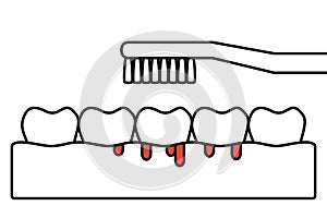 Gingivitis or scurvy, brushing teeth with bleeding on gum and tooth - dental cartoon vector outline flat style