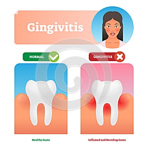 Gingivitis vector illustration. Medical oral mouth illness symptoms example photo