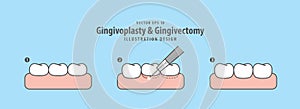 Gingivoplasty & Gingivectomy step electrosurgery cut gum off illustration vector on blue background. Dental concept