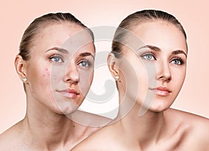 Girl with acne before and after treatment