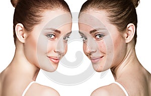 Girl with acne before and after treatment