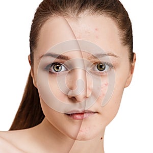 Girl with acne before and after treatment.