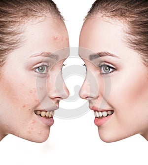 Girl with acne before and after treatment.