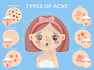 Girl with acne. Young unhappy female face with skin problems and pimple types icons. Dermatology and cosmetic skin care