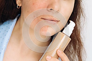 The girl applies a tonal corrective cream on a problematic pigmentation face.