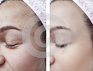 girl beauty skin wrinkles eyes removal before and after cosmetology procedures