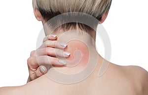 Girl with blond hair, sitting with his back turned and scratching bitten, red, swollen neck skin from mosquito bites in the summer