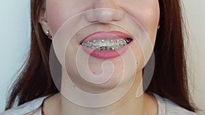 A girl with braces on her teeth and colored rubber bands smiles.