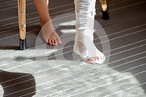 Girl with a broken leg .close-up of feet, one with a plaster bandage. foot splint for treatment of injuries from broken