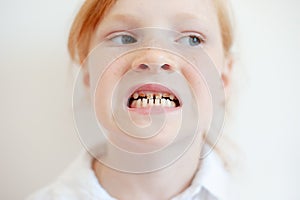 A girl with dental caries