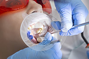 Girl on examination at dentist. treatment of carious tooth. the doctor uses a mirror on the handle and a boron machine