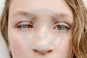 Girl with eye infection