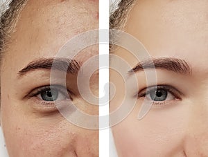 Girl eye treatment, before and after procedures, acne