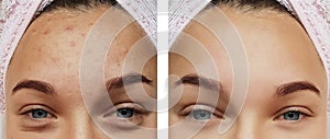 Girl eye treatment closeup , removal before and after procedures, therapy acne photo