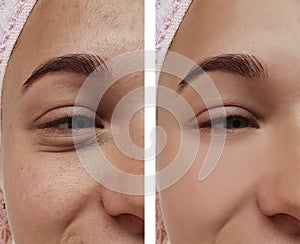 Girl eye treatment, before and after procedures, therapy acne