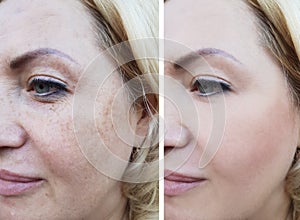Girl face wrinkles before and after, correction cosmetic lifting pigmentation