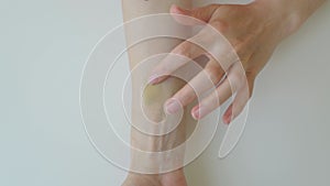 Girl hand smears bruise ointment close up. A caucasian woman applies a special healing gel with a pipette to an abrasion
