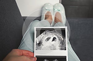 The girl is holding a snapshot of an ultrasound twin in the fourth week of pregnancy. First trimester. Selective focus.