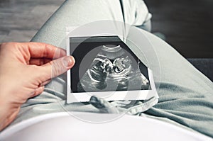A girl holds a picture of an ultrasound baby in her twentieth week of pregnancy. Second trimester Selective focus.