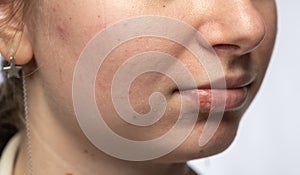Girl lips affected by herpes