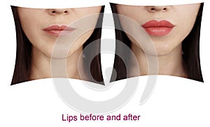 Girl lips before and after augmentation